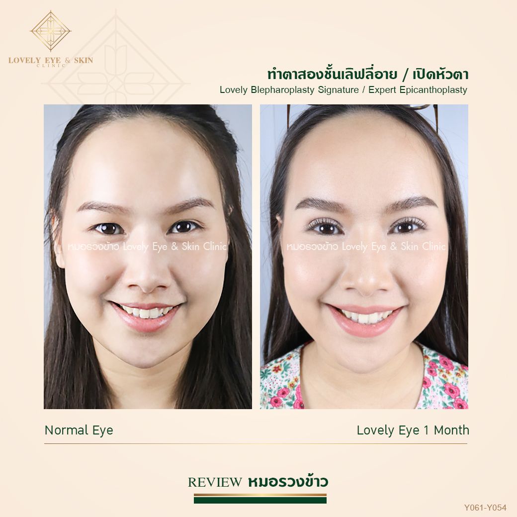 Double eyelid surgery with Dr Ruang Khao lovelyeye technique