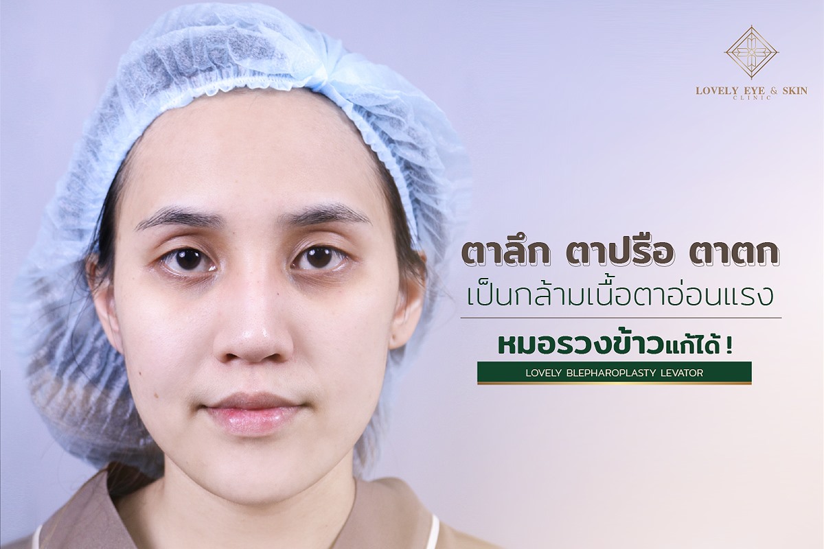 กล้ามเนื้อตาอ่อนแรง