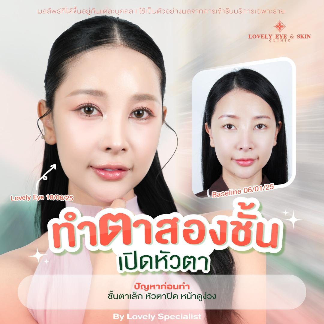 รีวิวเปิดหัวตา ที่ Lovely Eye & Skin Clinic