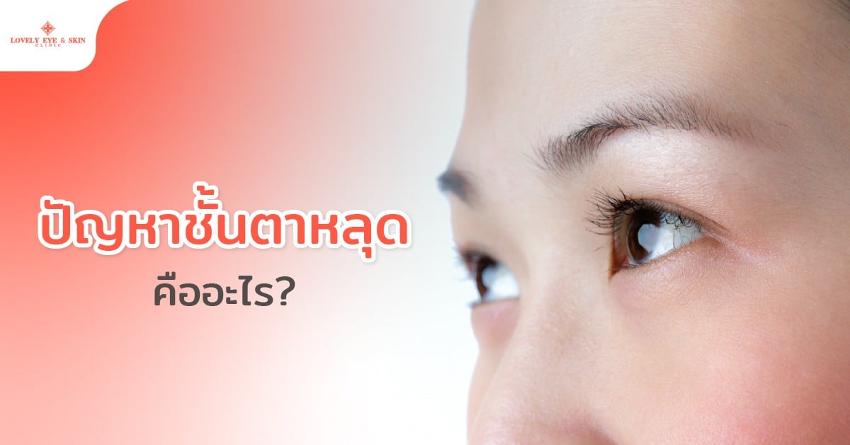 ปัญหาชั้นตาหลุดคืออะไร?