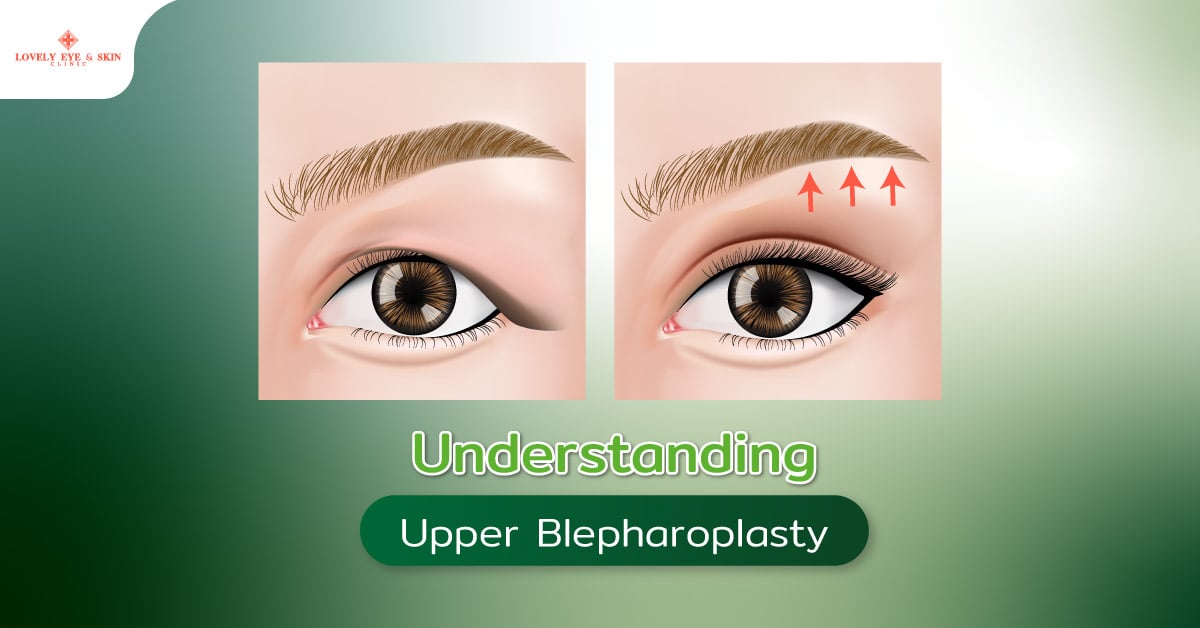 Understanding Upper Blepharoplasty