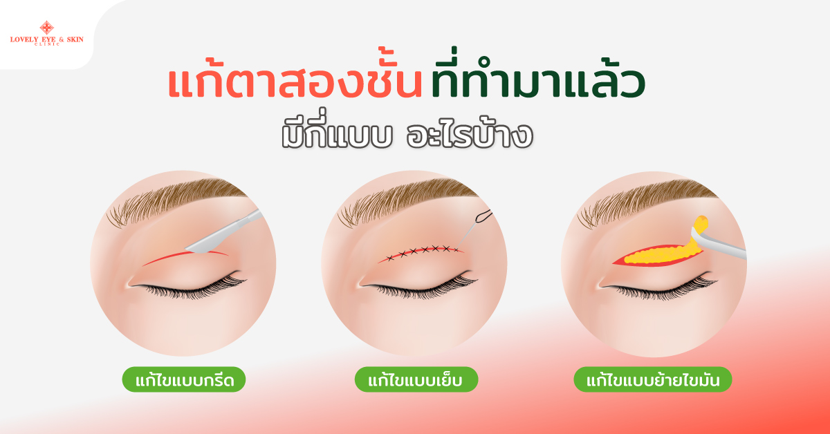 แก้ตาสองชั้นที่ทำมาแล้วมีกี่แบบ อะไรบ้าง