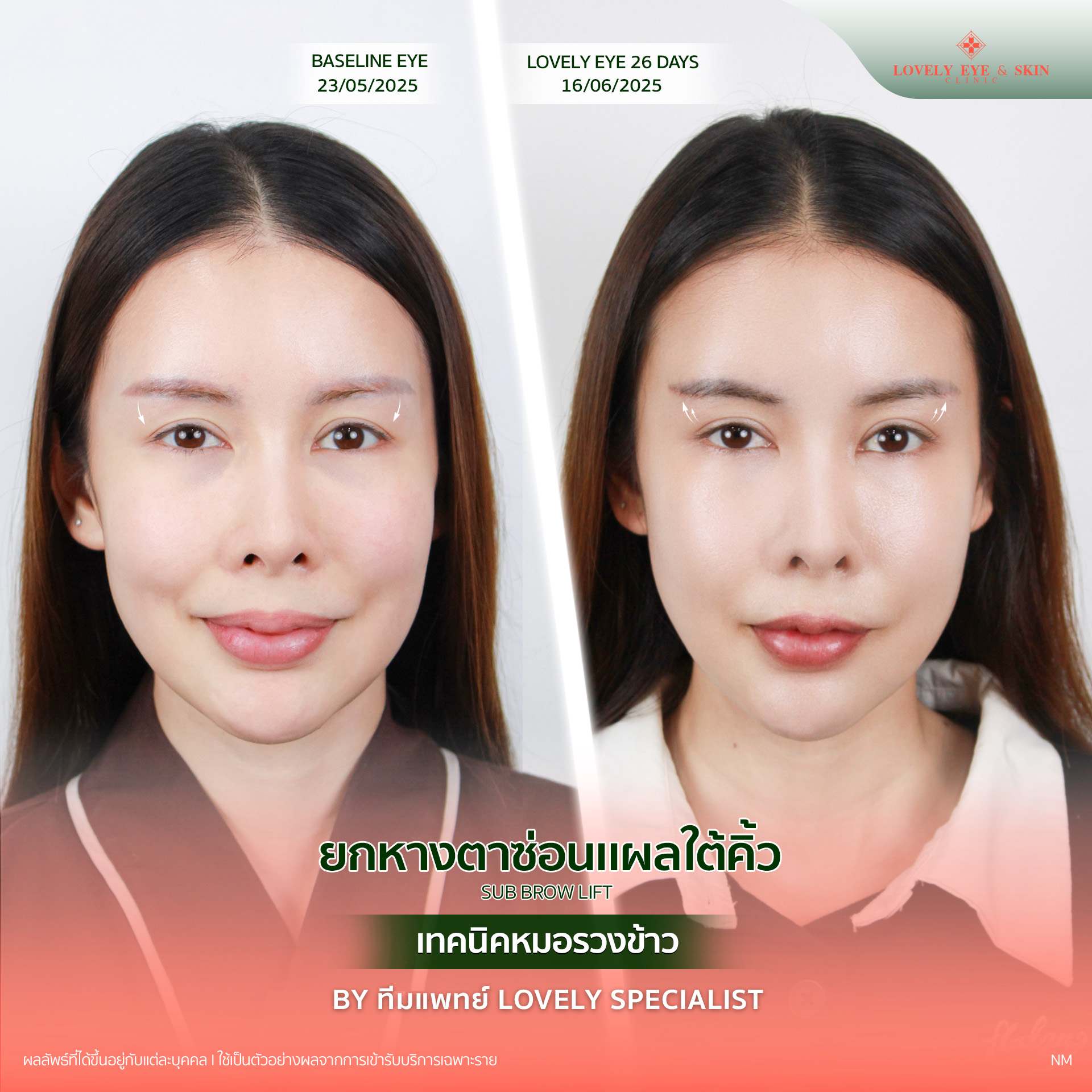 รีวิว Before-After ปรับโหงวเฮ้งตาที่ Lovely Eye