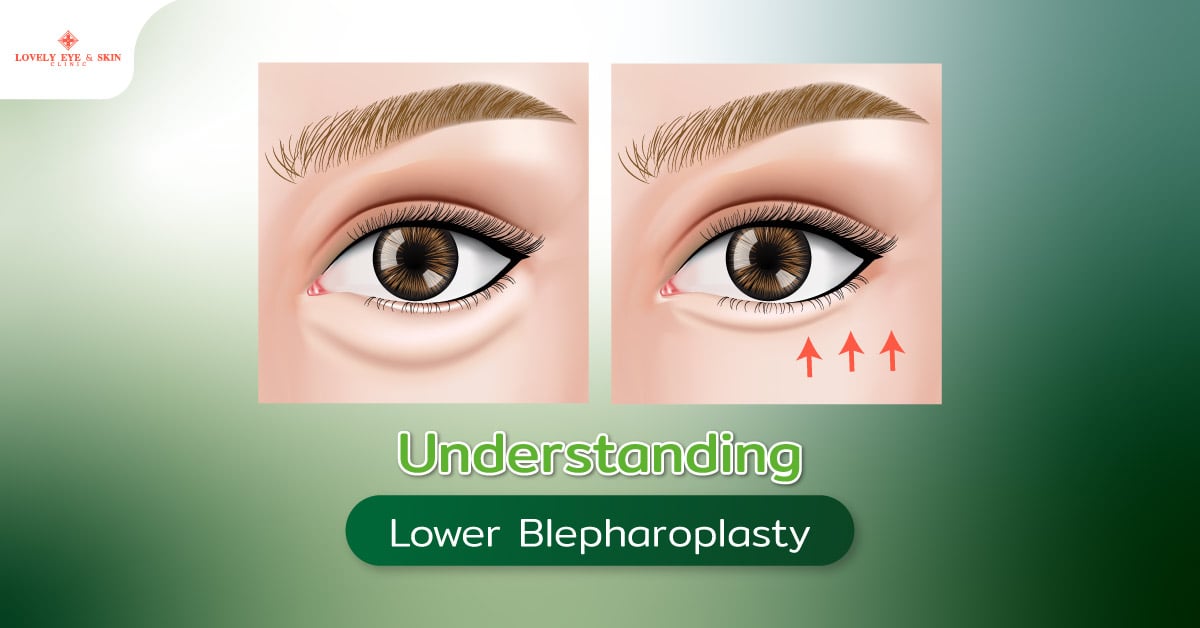 Understanding Lower Blepharoplasty