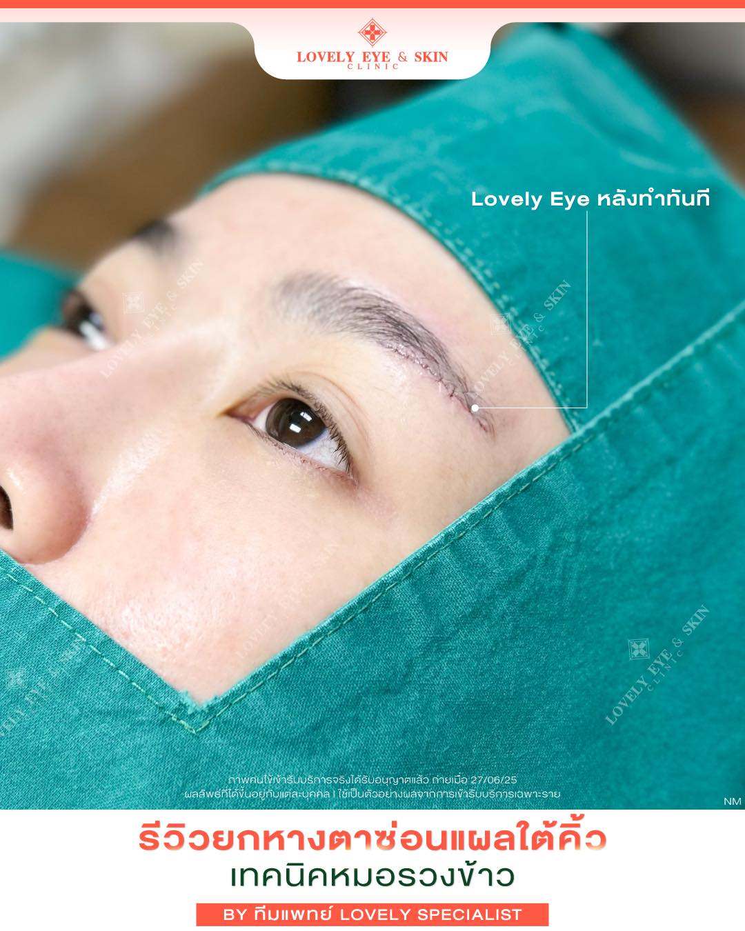 รีวิว Before-After ปรับโหงวเฮ้งตาที่ Lovely Eye
