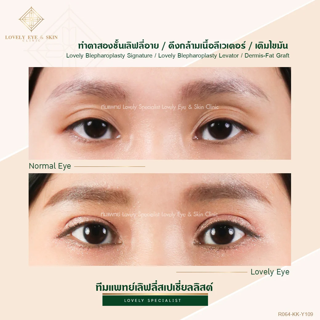 รีวิวแก้ไขกล้ามเนื้อตาอ่อนแรงที่ Lovely Eye & Skin Clinic