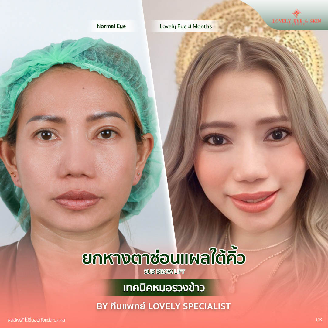 รีวิวยกหางตาที่ Lovely Eye & Skin Clinic