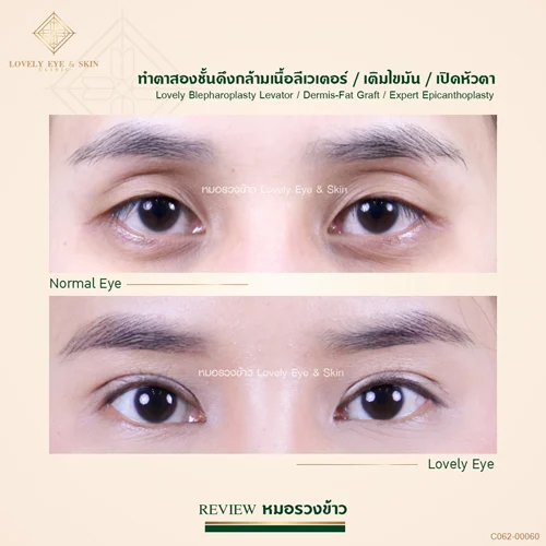 รีวิวแก้ไขกล้ามเนื้อตาอ่อนแรงที่ Lovely Eye & Skin Clinic