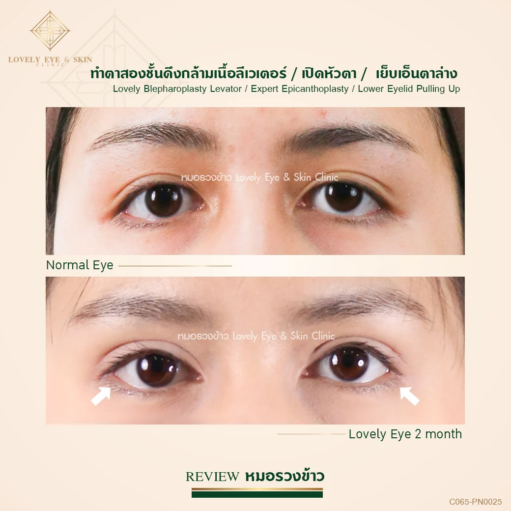 รีวิวเคสเย็บเอ็นตาล่างที่ Lovely Eye