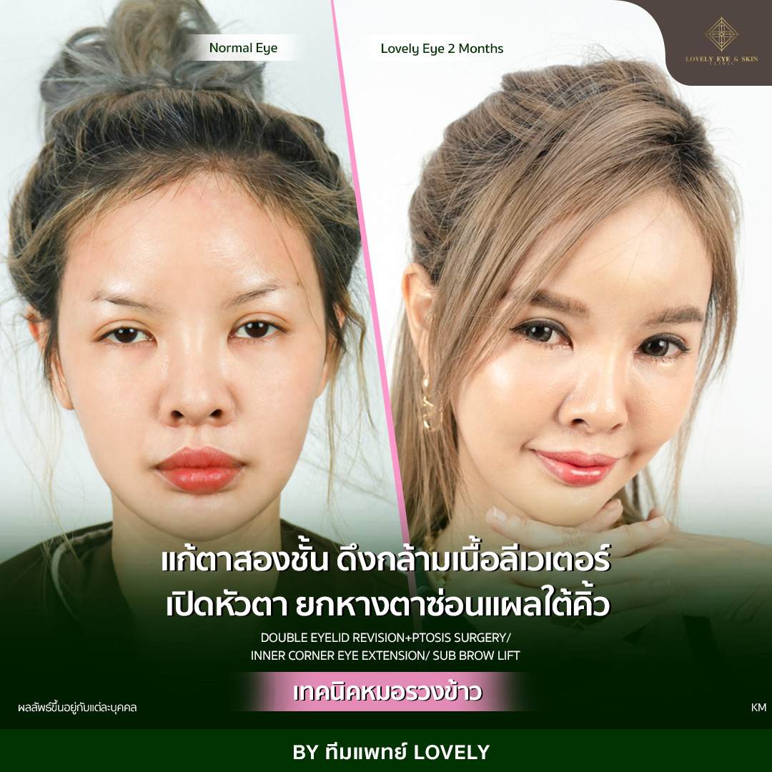 รีวิวแก้ไขตาสองชั้น