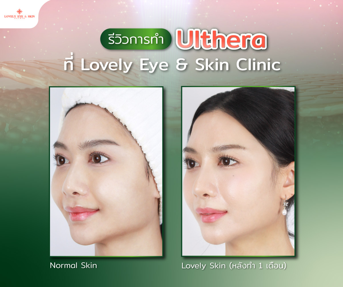 รีวิวการทำ Ulthera ที่ Lovely Eye & Skin Clinic