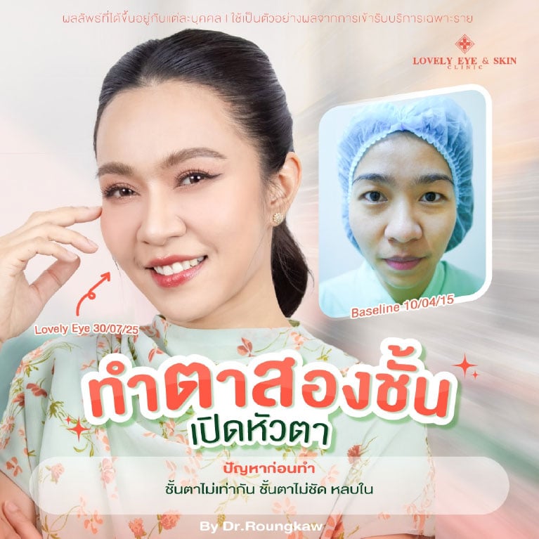 รีวิวทำตาสองชั้นที่ Lovely Eye & Skin Clinic