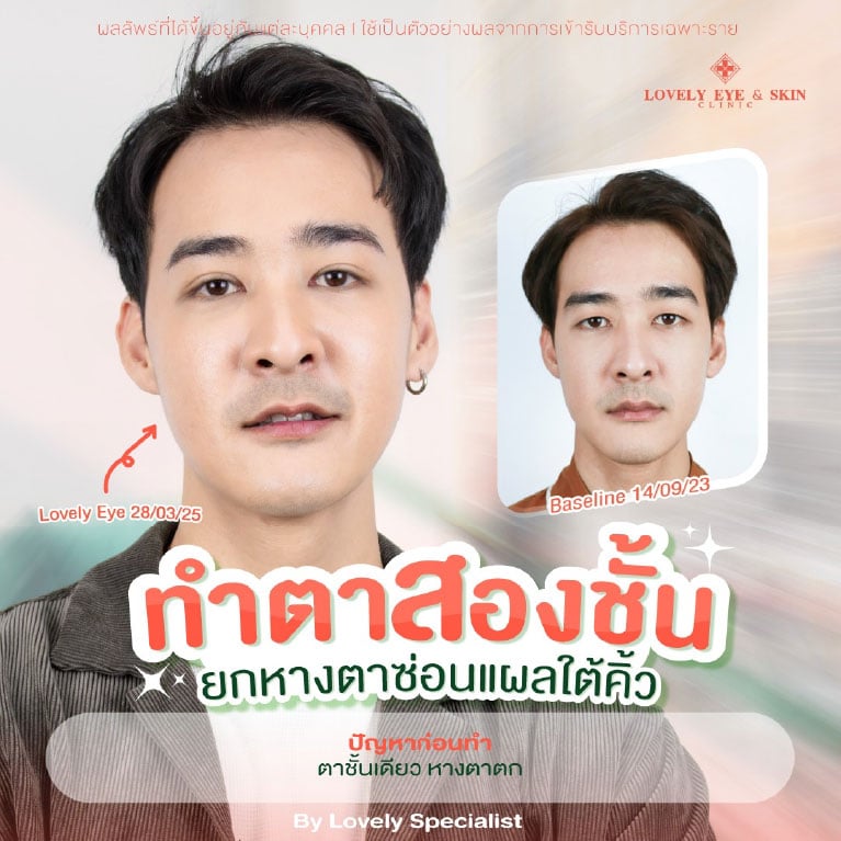 รีวิวทำตาสองชั้นที่ Lovely Eye & Skin Clinic