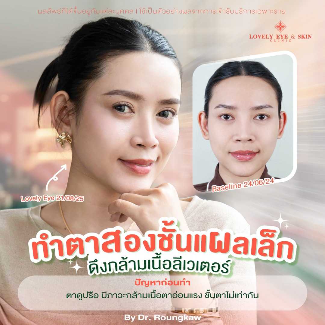 รีวิวทำตาสองชั้นแผลเล็กที่ Lovely Eye & Skin Clinic