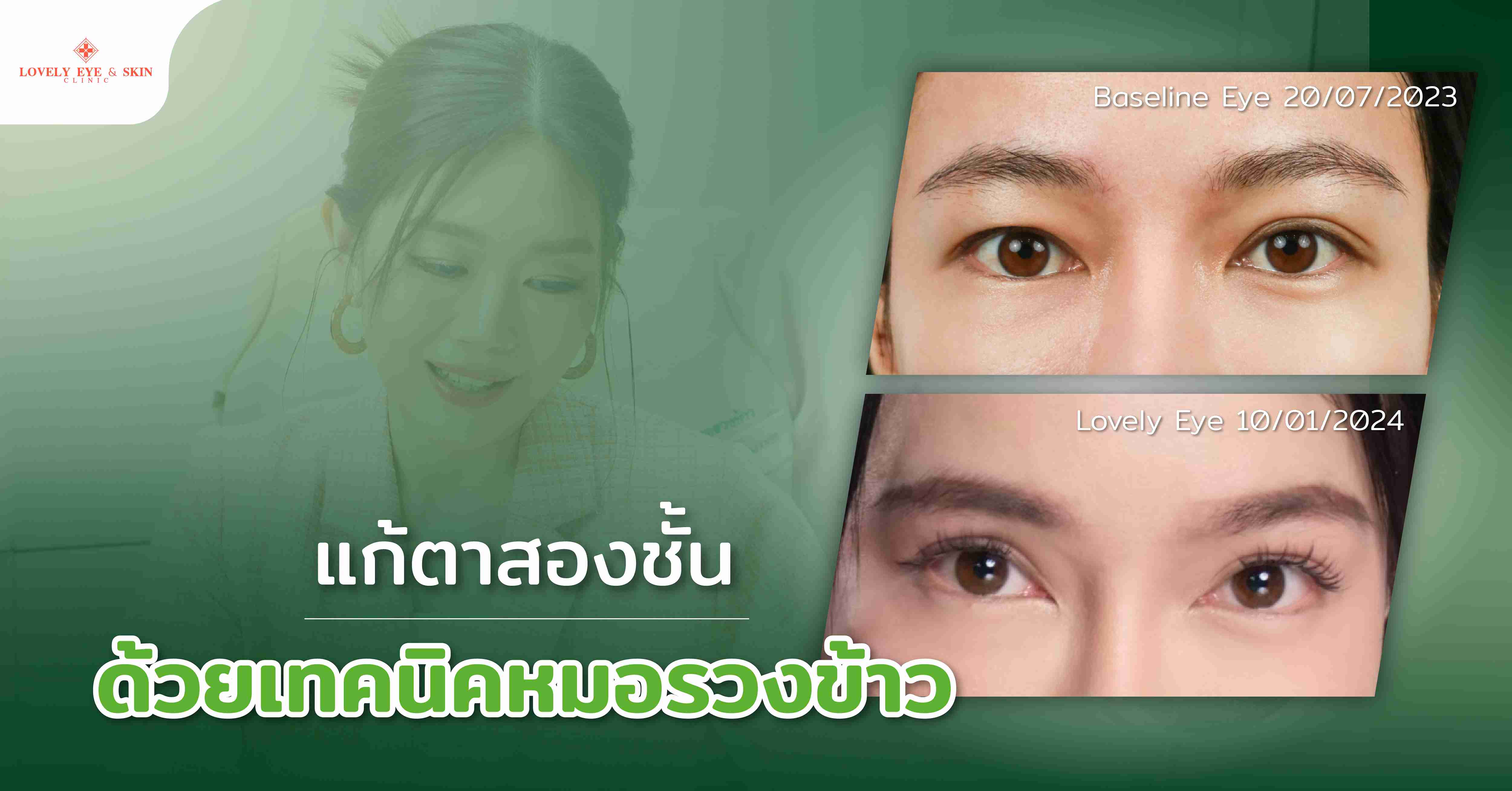 แก้ตาสองชั้น ด้วยเทคนิคหมอรวงข้าว