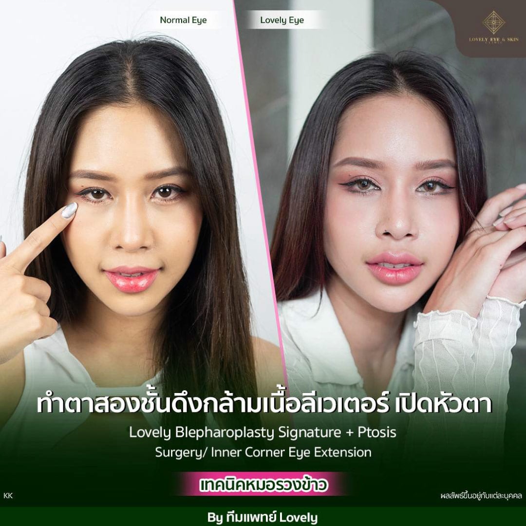 รีวิวทำตาสองชั้นที่ Lovely Eye & Skin Clinic