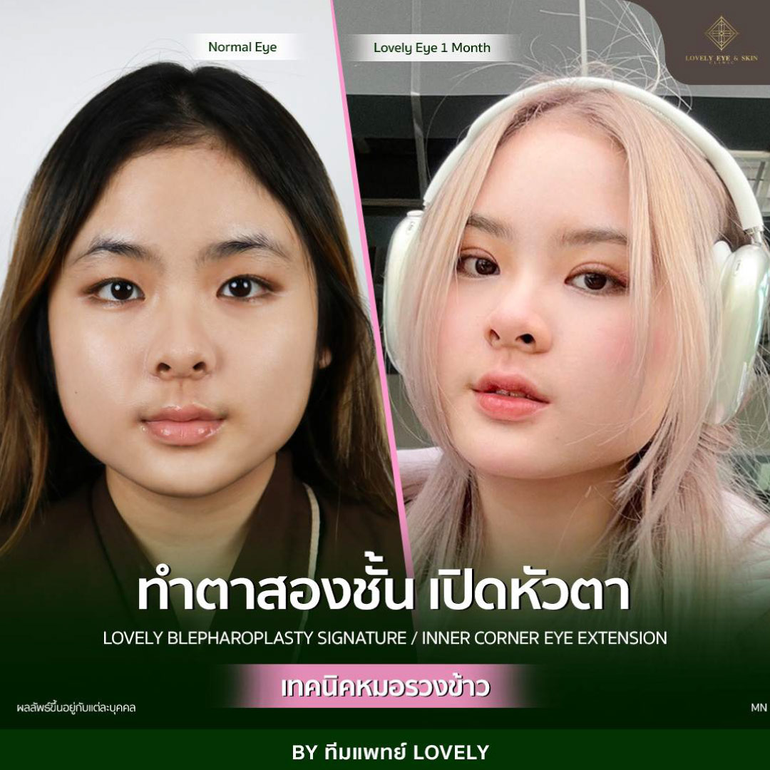 รีวิวทำตาสองชั้นที่ Lovely Eye Clinic