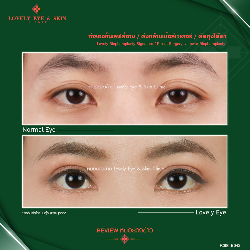ตัวอย่างการผ่าตัดศัลยกรรมถุงใต้ตา