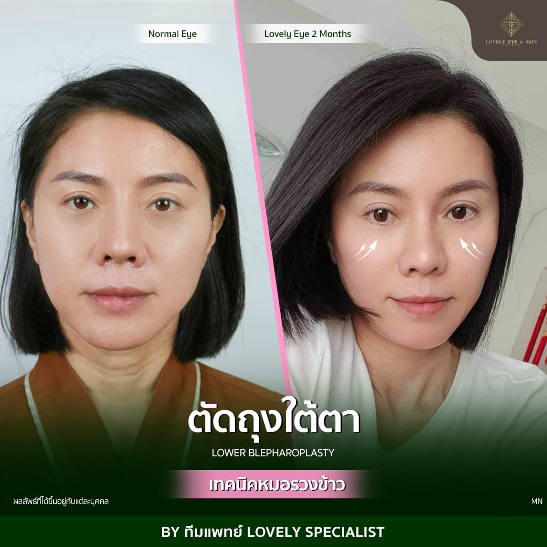ตัดถุงใต้ตา เทคนิคหมอรวงข้าว