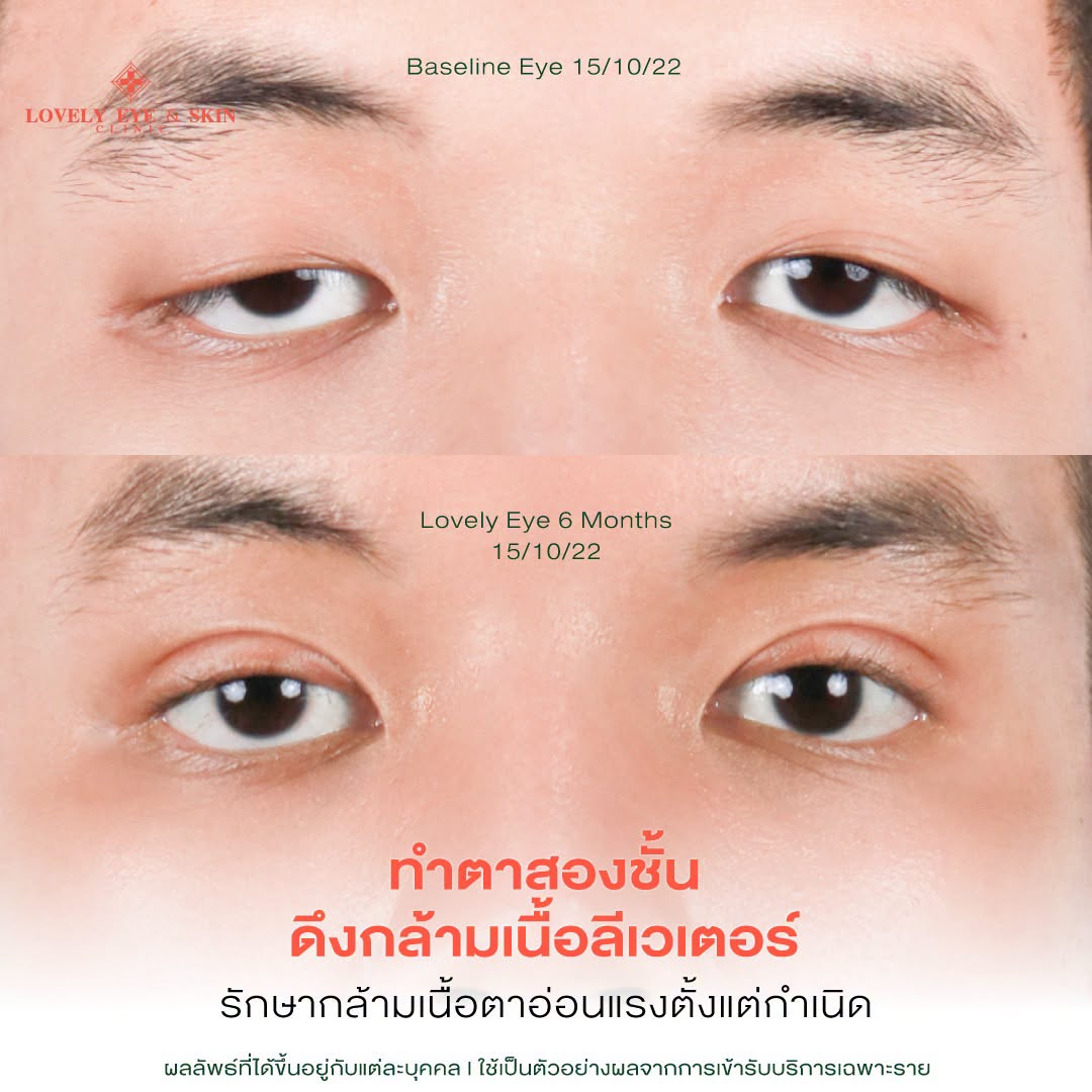 รีวิวเคสทำตาสองชั้น ที่ Lovely Eye & Skin Clinic 3