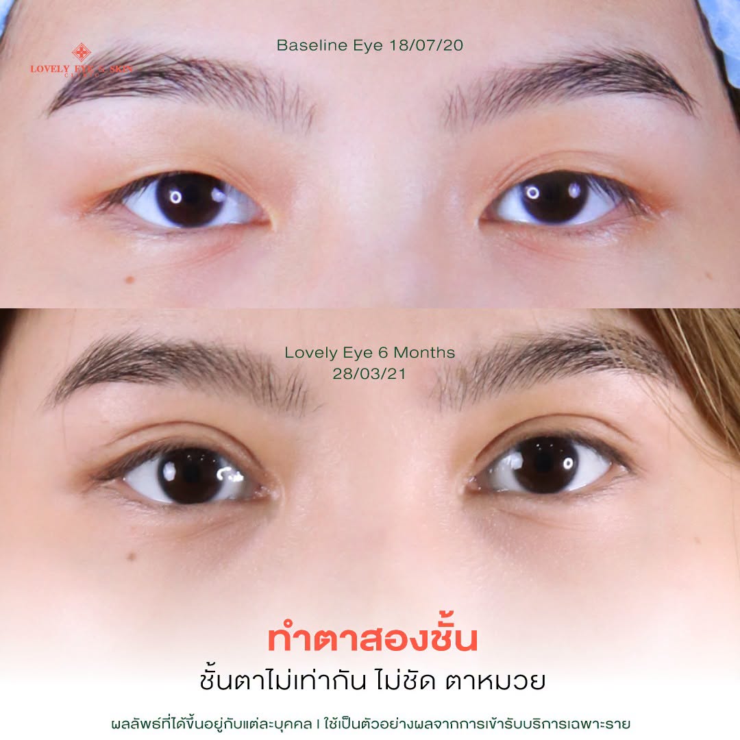 รีวิวเคสทำตาสองชั้น ที่ Lovely Eye & Skin Clinic 4