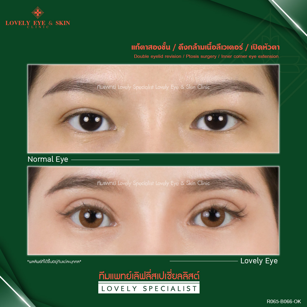รักษาจากการผ่าตัด