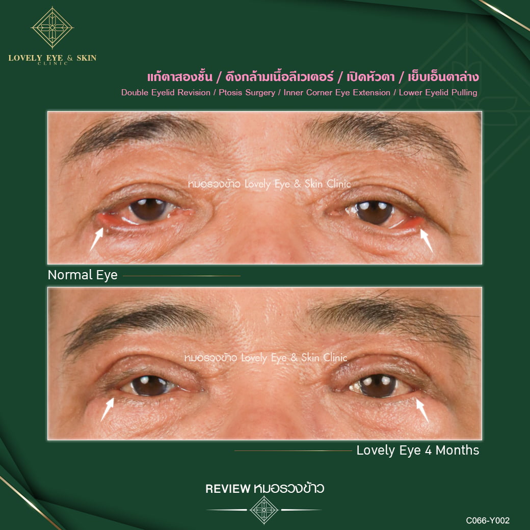 แก้ปัญหาถุงใต้ตา โดย Lovely Eye Clinic