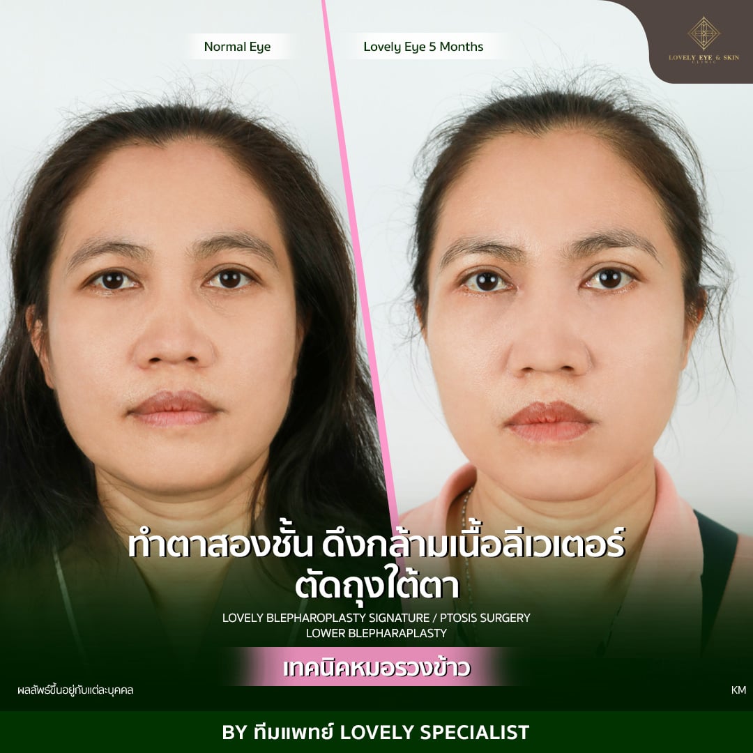 Face before and after plastic surgery