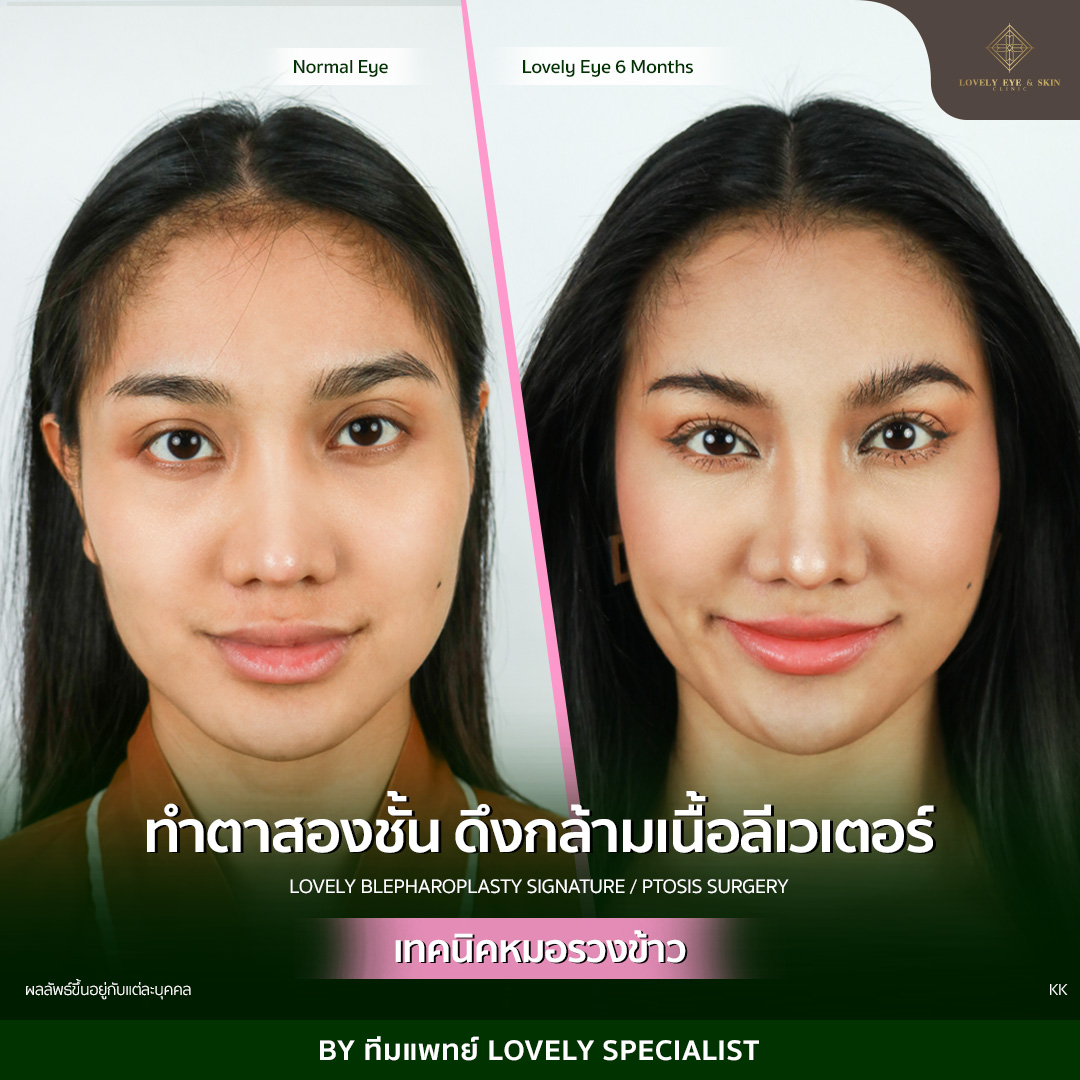 ทำตาสองชั้น แก้ปัญหาตาปรือ ดูไม่สดใส