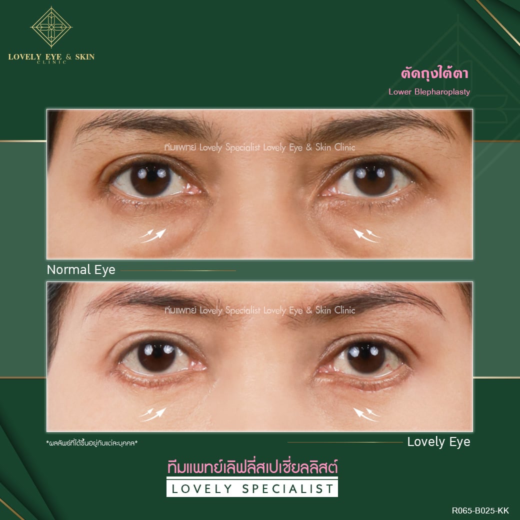 ตัดถุงใต้ตา Lovely Eye