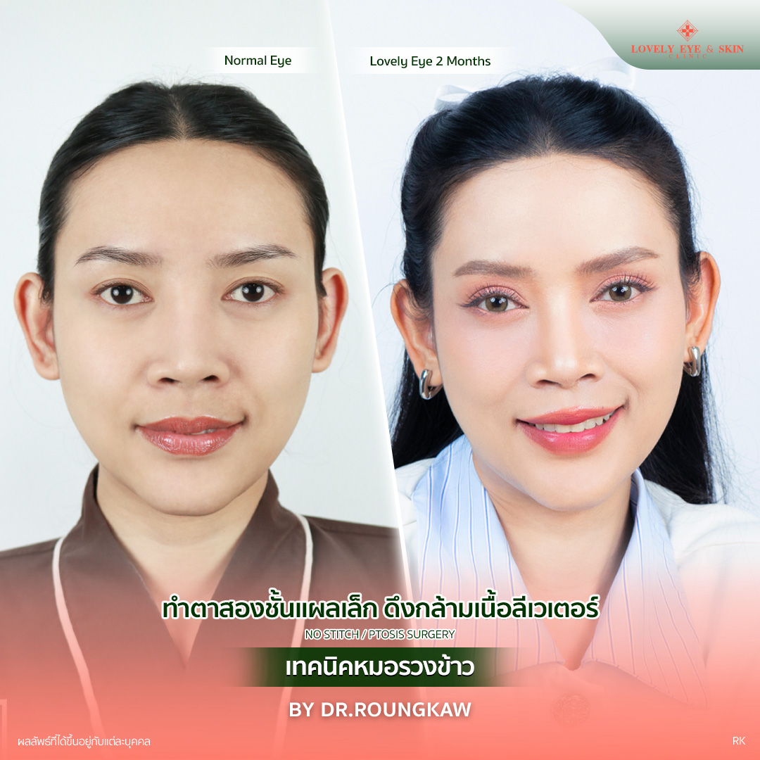 ทำตาสองชั้นแผลเล็ก แก้ไขกล้ามเนื้อตาอ่อนแรง