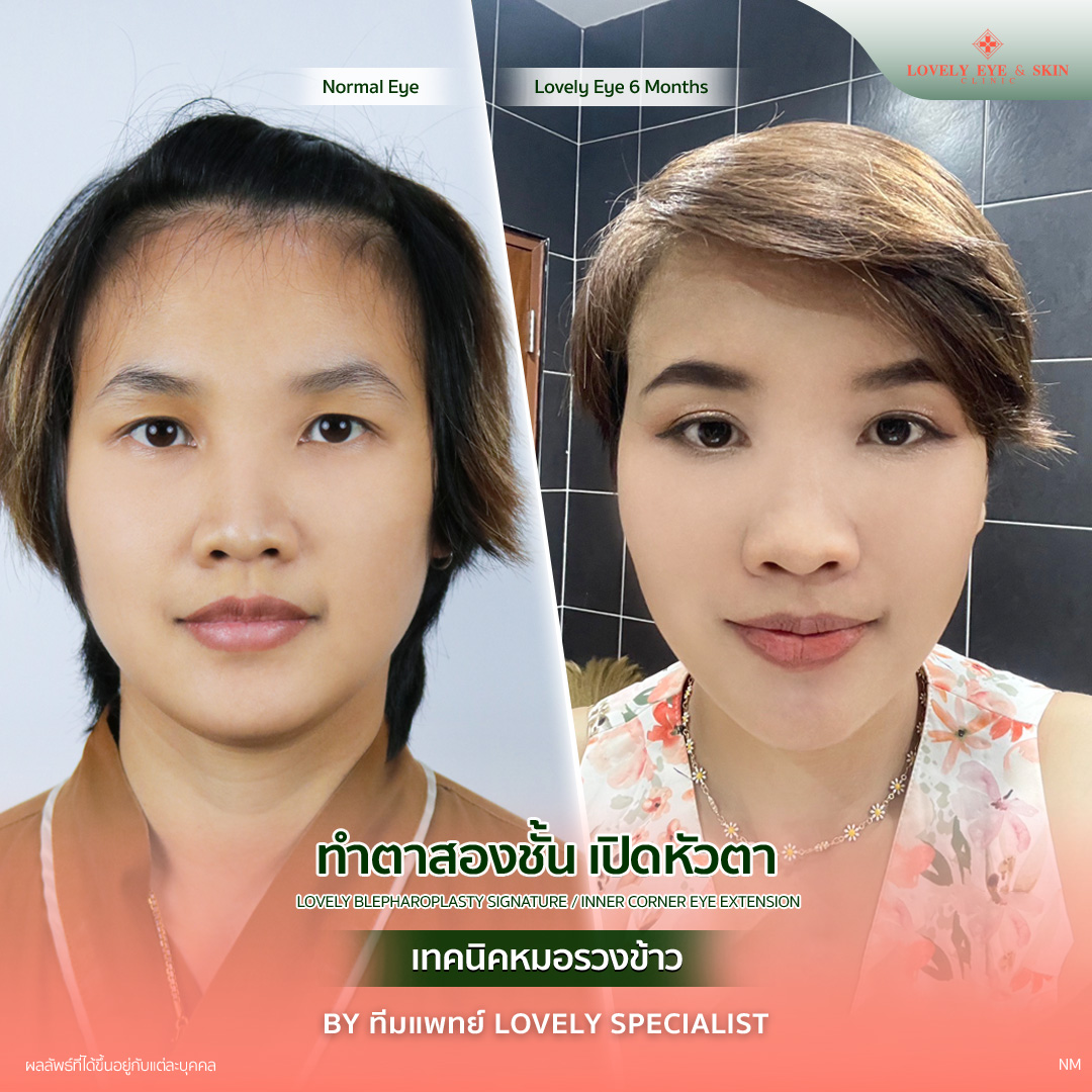 ทำตาสองชั้น แก้ไขหนังตาตก
