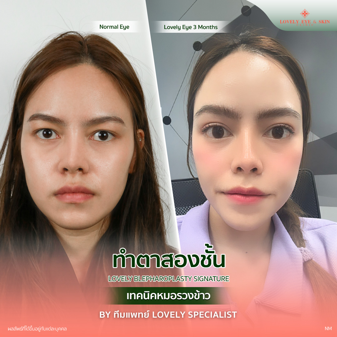 ทำตาสองชั้น แก้ปัญหาตาหลบใน