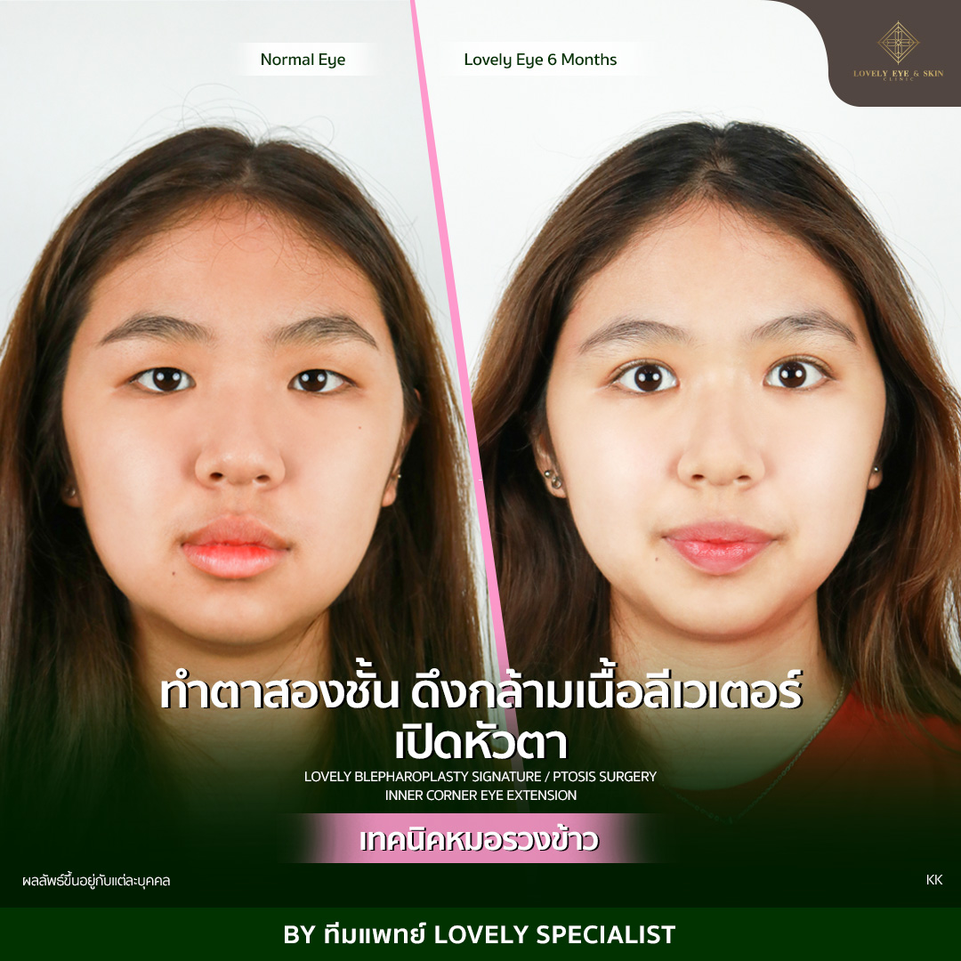 ทำตาสองชั้น เปิดหัวตา แก้ปัญหาตาชั้นเดียว หัวตาปิด