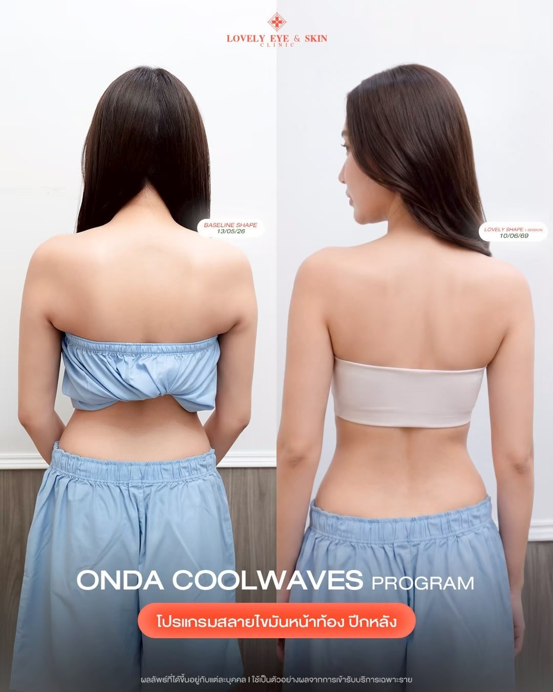 รีวิว ONDA Coolwaves Program ที่ Lovely Eye & Skin Clinic 1