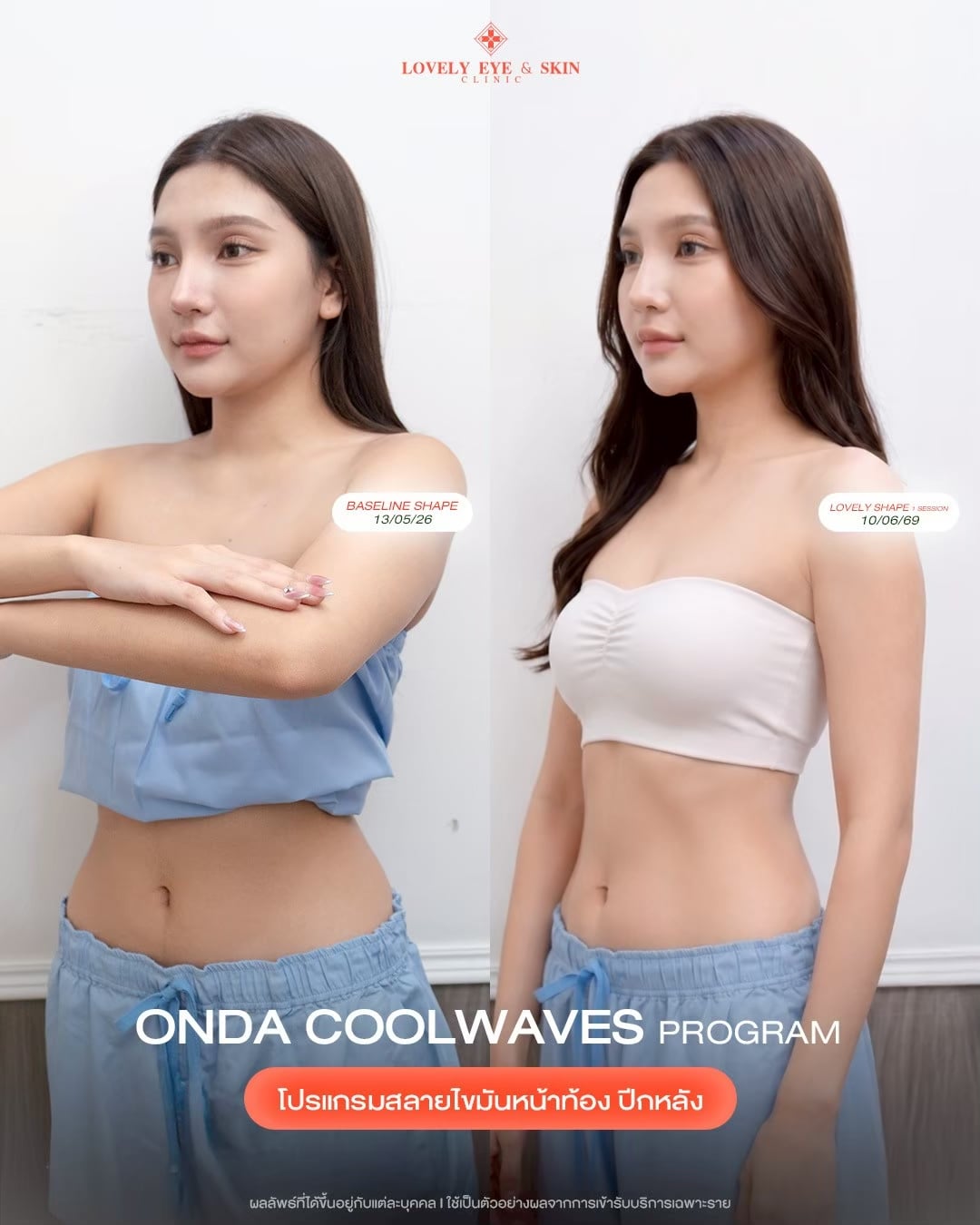 รีวิว ONDA Coolwaves Program ที่ Lovely Eye & Skin Clinic 2
