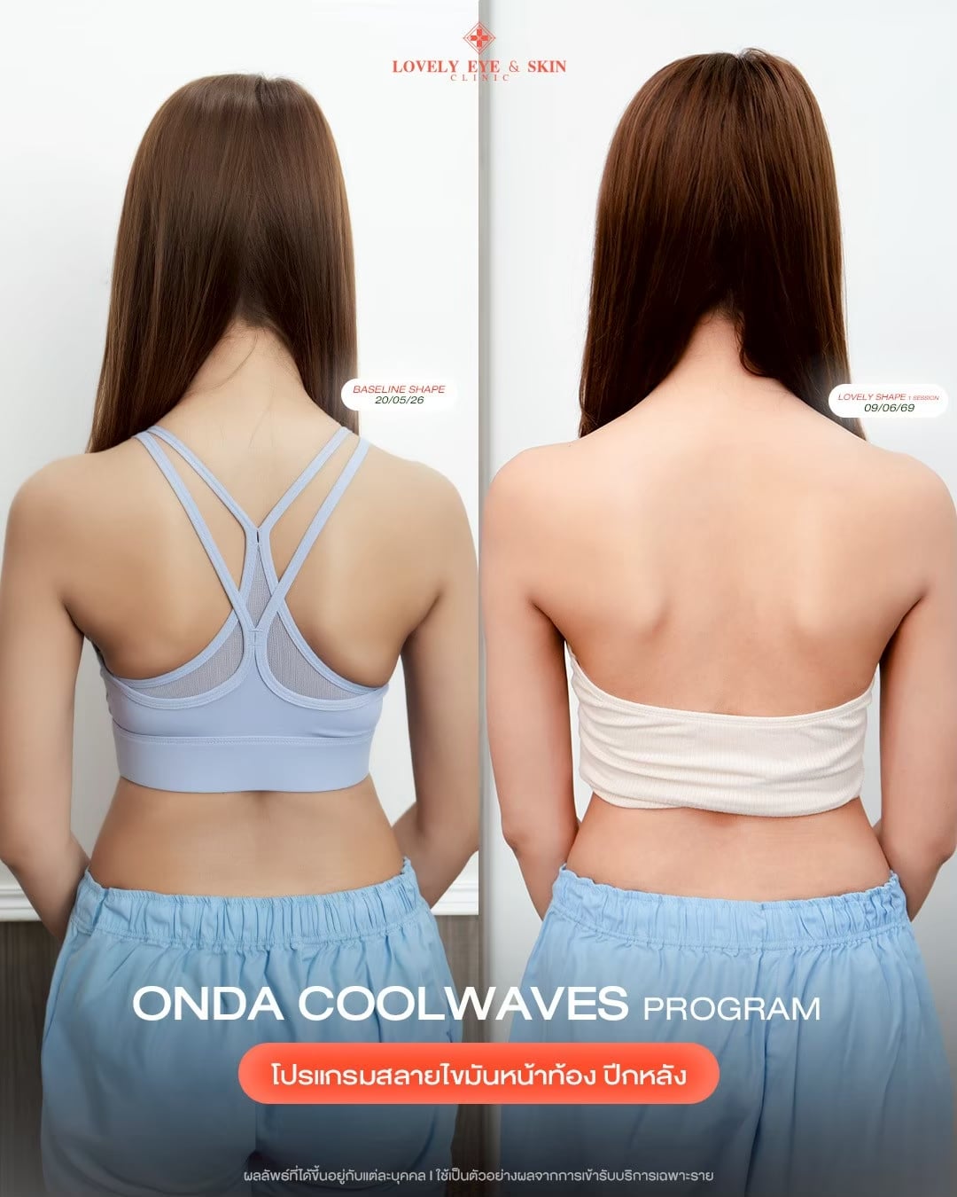 รีวิว ONDA Coolwaves Program ที่ Lovely Eye & Skin Clinic 4