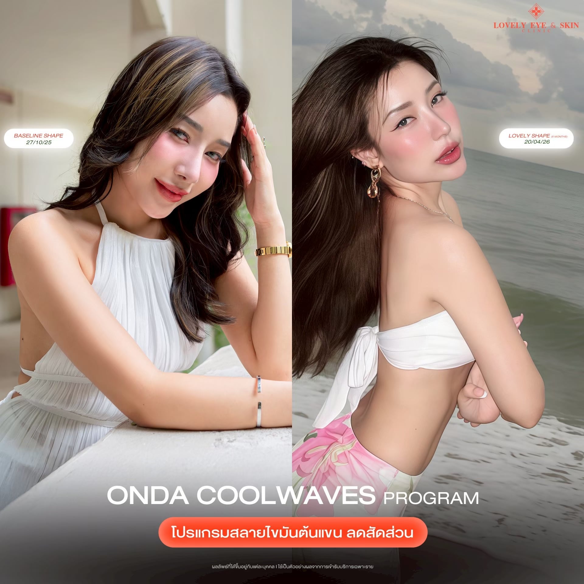 รีวิว ONDA Coolwaves Program ที่ Lovely Eye & Skin Clinic 5