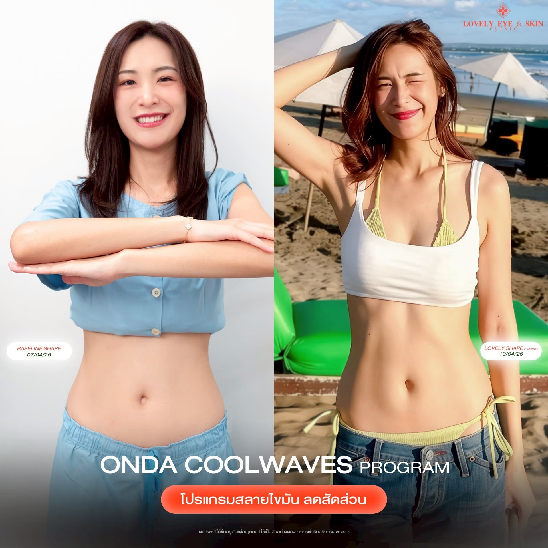 รีวิว ONDA Coolwaves Program ที่ Lovely Eye & Skin Clinic 6