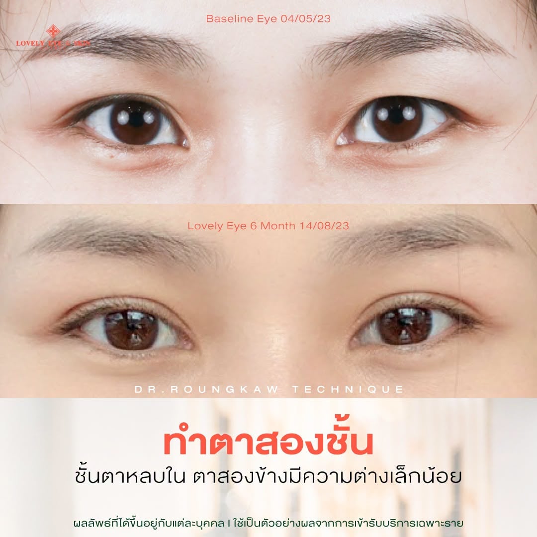 รีวิวเคสทำตาสองชั้น ที่ Lovely Eye & Skin Clinic 1