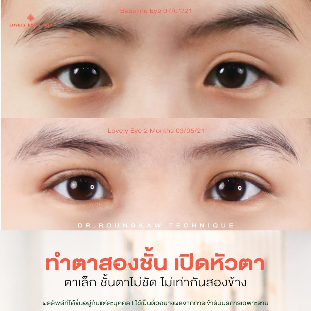 รีวิวเคสทำตาสองชั้น ที่ Lovely Eye & Skin Clinic 2