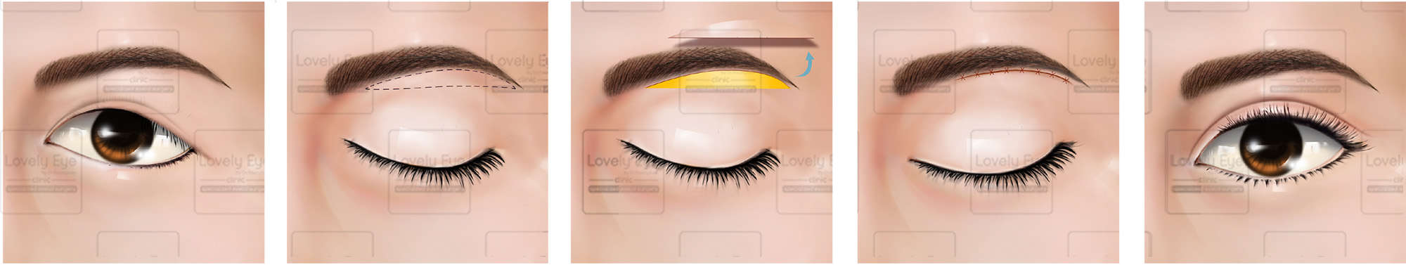 Various treatments for droopy eyes by Lovely Eye & Skin Clinic’s technique