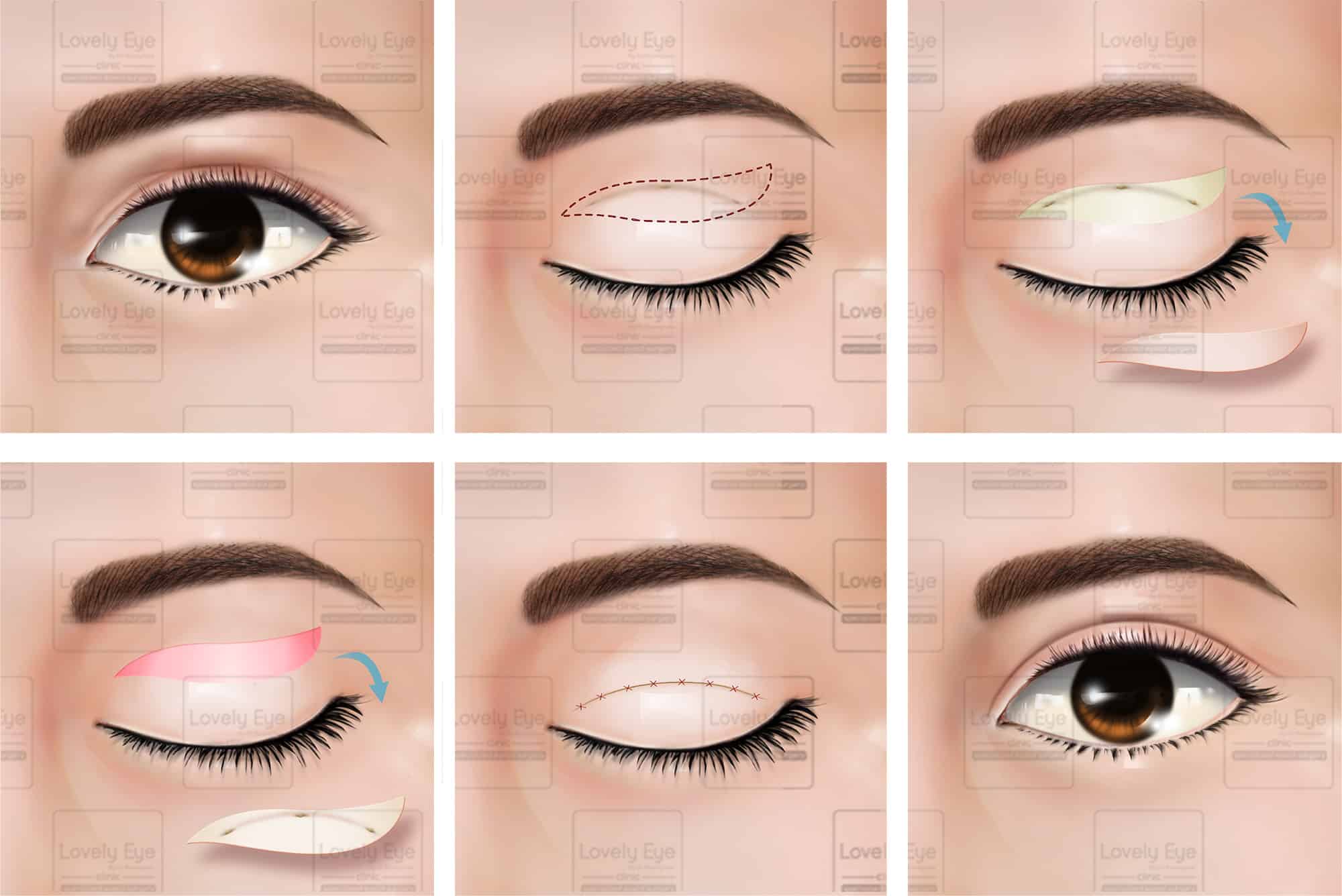 Double eyelid correction technique Dr.Roungkaw