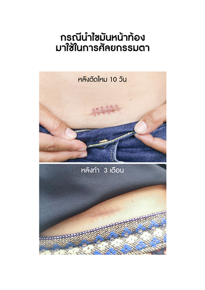 เติมไขมันเบ้าตา แก้ชั้นตาสูง แก้เบ้าตาลึก