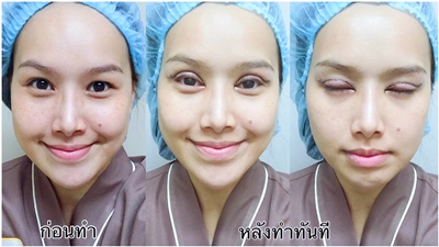 ทำตาสองชั้น เปิดหัวตา