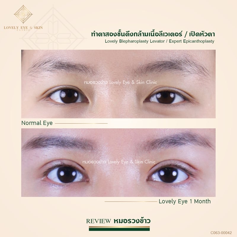 ทำตาสองชั้นดึงกล้ามเนื้อลีเวเตอร์ พร้อมเปิดหัวตาเทคนิคหมอรวงข้าว 