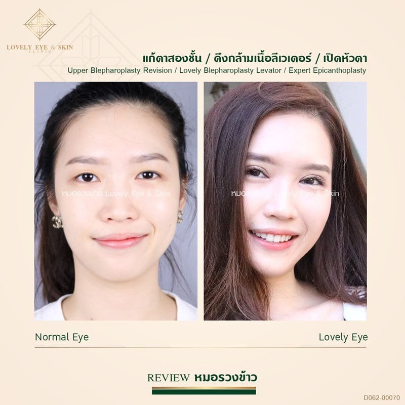 เคยทำตาสองชั้นมาแล้ว แต่ยังมีหนังตาส่วนเกิน ทำให้ชั้นตาหลบใน