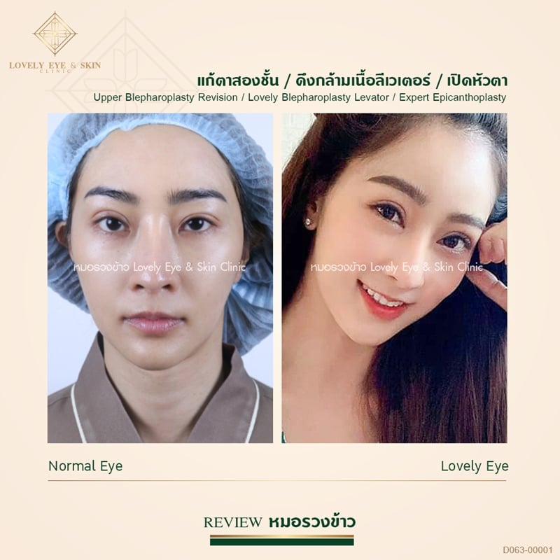 เคยทำตาสองชั้น กล้ามเนื้อตาเปิดไม่เท่ากัน จึงแก้ตา พร้อมดึงกล้ามเนื้อตาลีเวเตอร์ และเปิดหัวตาเทคนิคหมอรวงข้าว