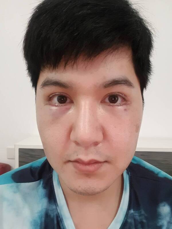 ตัดถุงใต้ตา 12_5_23 (3).jpg