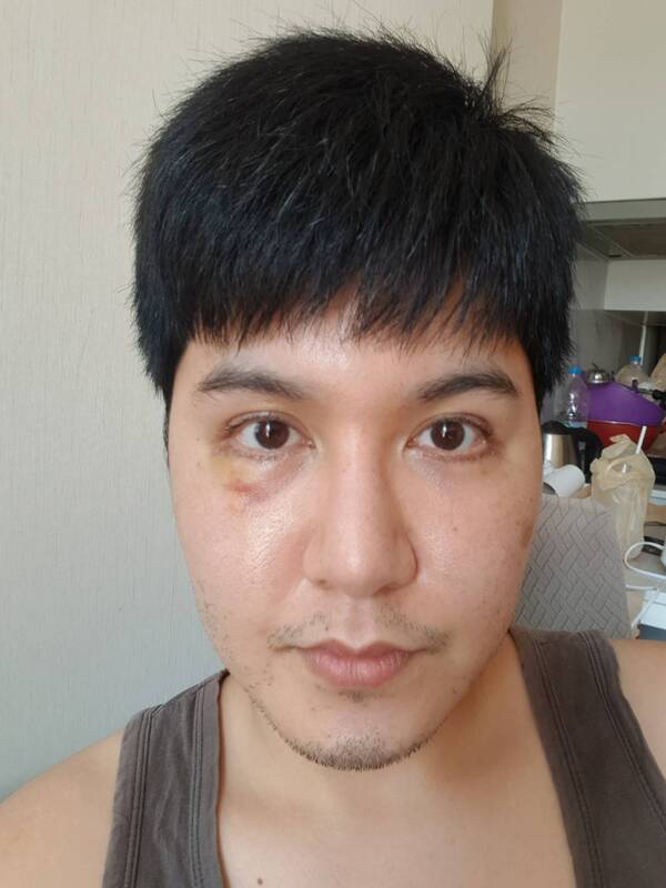 ตัดถุงใต้ตา 12_5_23 (4).jpg